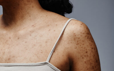 Jak skutecznie walczyć z przebarwieniami na skórze? 