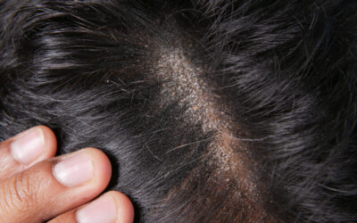 Łupież – przyczyny, rodzaje. Porady eksperta